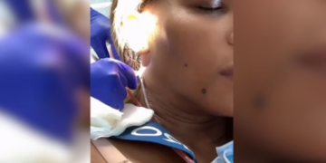 Ex-tenista Serena Williams passa por cirurgia para retirada de cisto