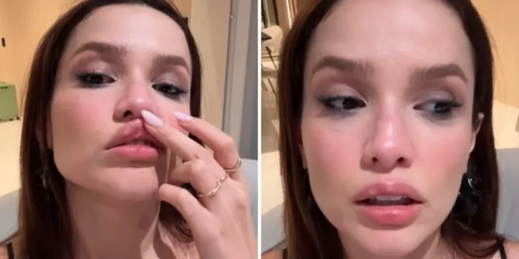 Juliette sofre microfratura no nariz após acidente doméstico: “Está meio torto”